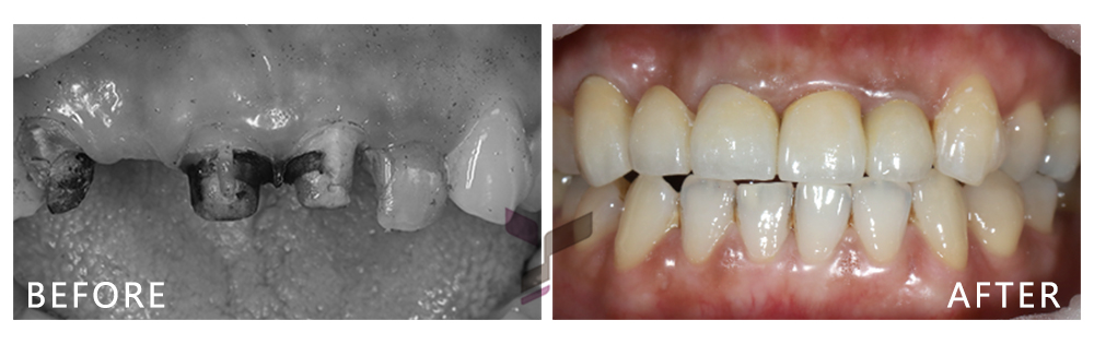 植牙案例-蔡小姐