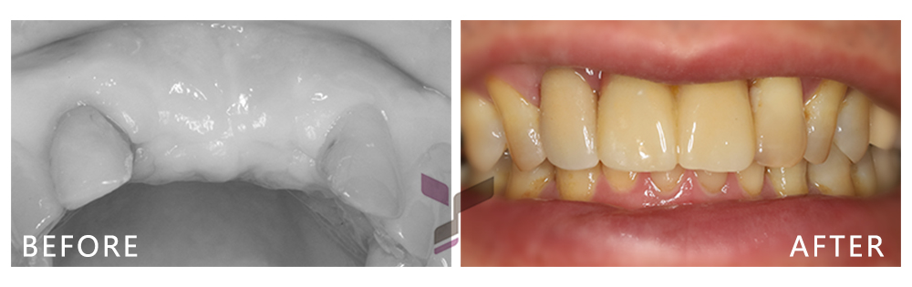 悠仕牙醫-植牙案例